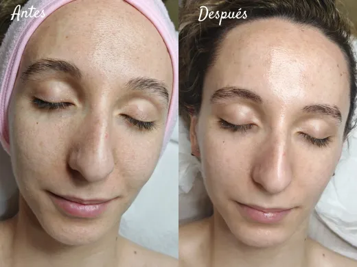 Tratamiento facial antes y después; mujer con la piel más clara y luminosa. Un lado muestra la piel más áspera, el otro, más suave.