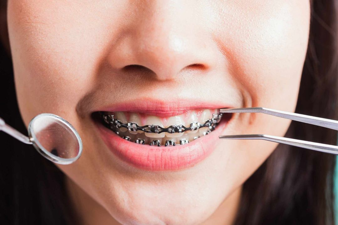 Una mujer con aparatos ortopédicos se hace examinar los dientes por un dentista.