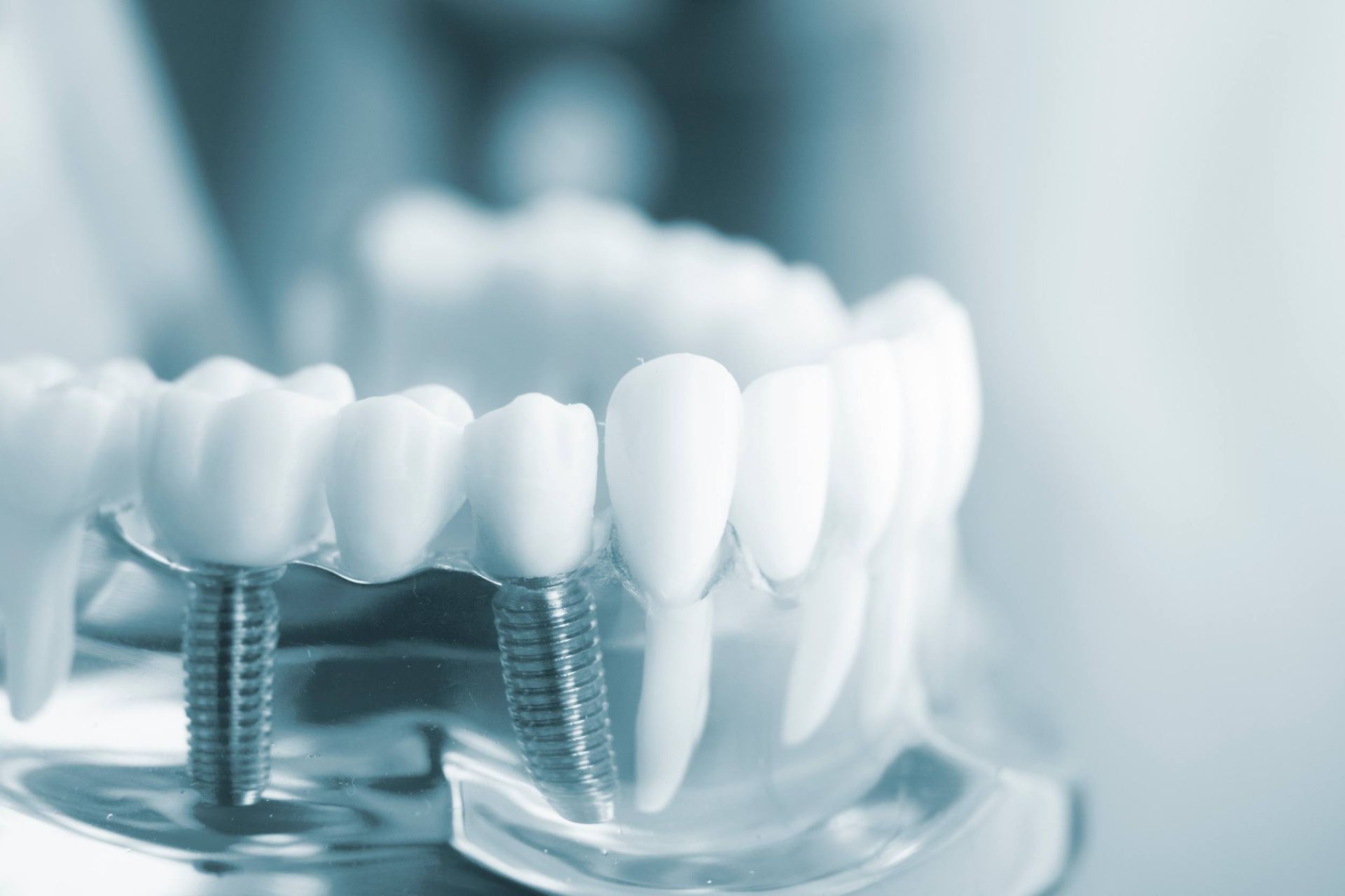 Un primer plano de un modelo de los dientes de una persona con implantes dentales.