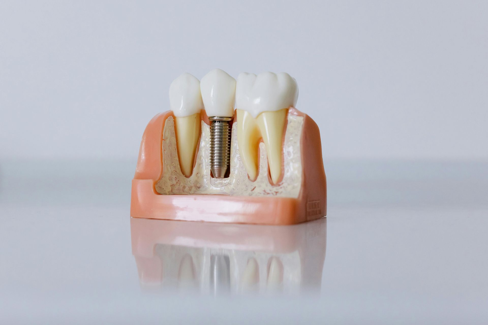 Un modelo de un diente con un implante dental en él.