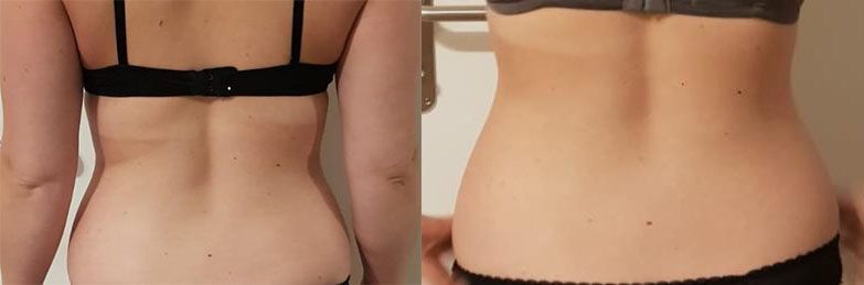 Ein Vorher-Nachher-Bild des Rückens einer Frau in BH und Unterwäsche.