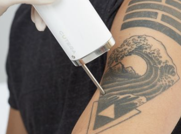 Dé-tatouage laser ciblant un tatouage de vague noire sur le haut du bras