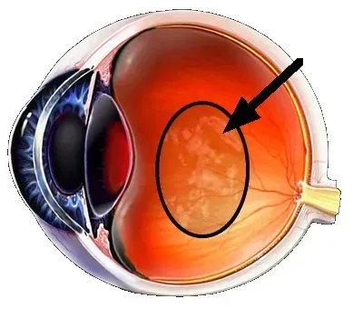 Diagrama de un ojo, resaltando la retina con un área circulada que muestra un aspecto moteado y enfermo.