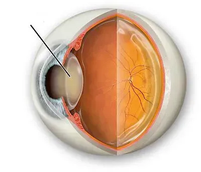 Corte transversal de un ojo, que muestra el cristalino, la retina y otras estructuras internas.