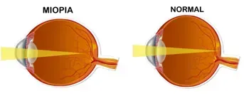 Diagrama que compara la visión del ojo miope con la del ojo normal. El ojo miope enfoca la luz delante de la retina. El ojo normal enfoca la luz en la retina.