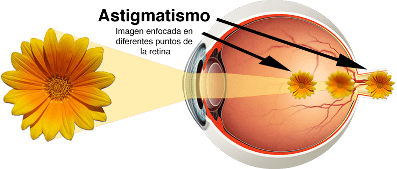 Diagrama que ilustra el astigmatismo: la luz de una flor se enfoca en múltiples puntos de la retina.