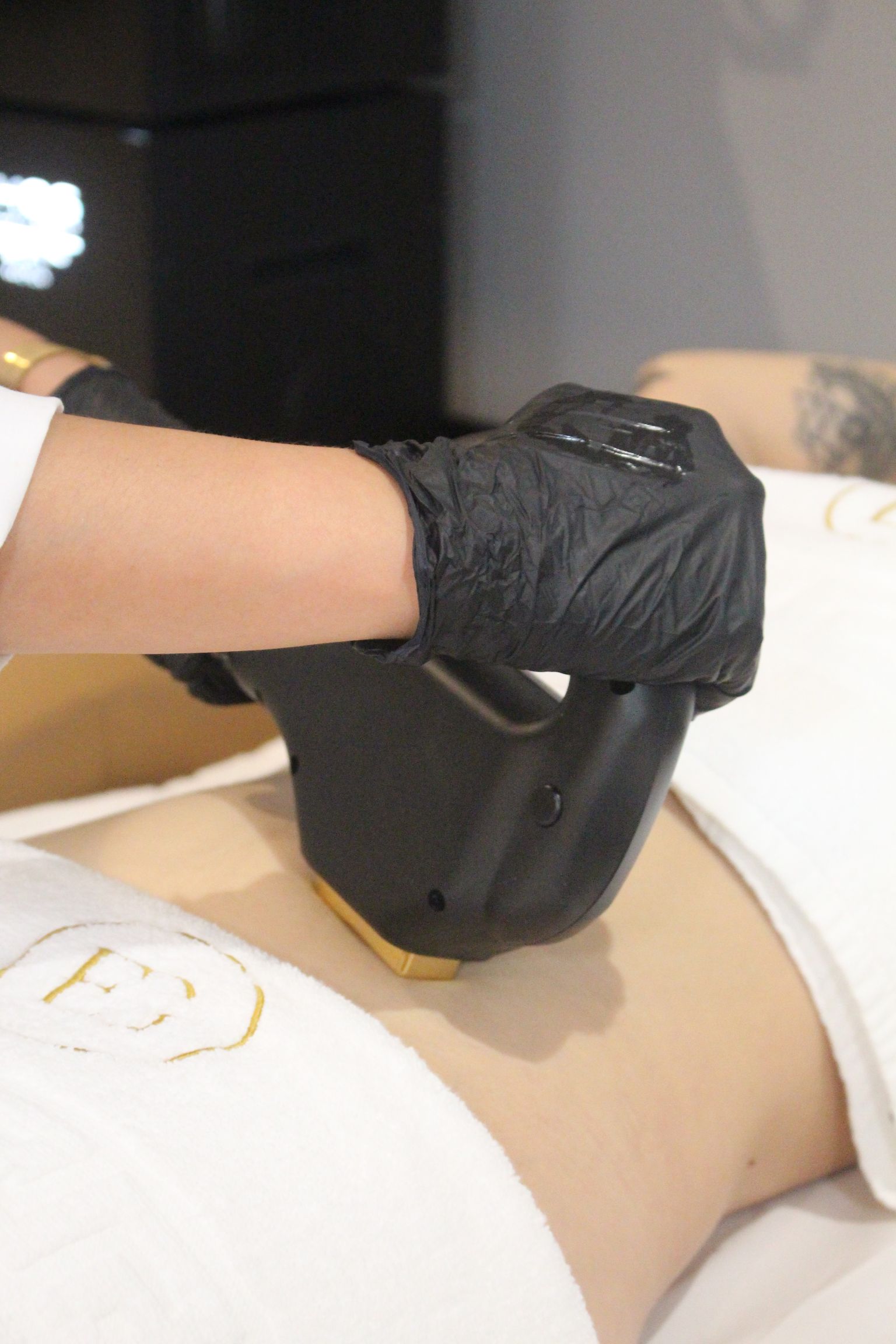 Una mujer está recibiendo un tratamiento con láser en su estómago.