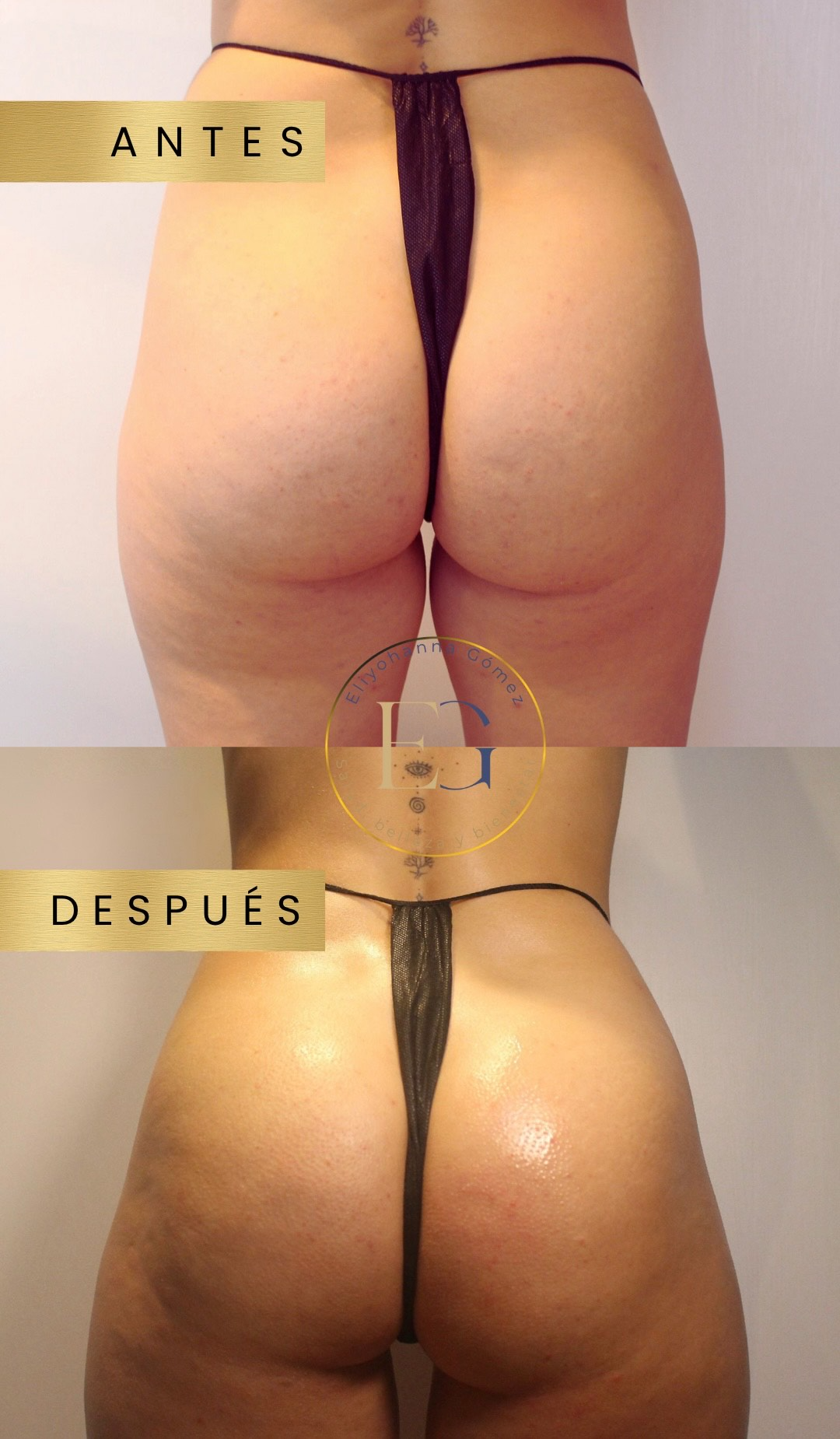 Comparación del antes y el después de los glúteos de una persona. La imagen del