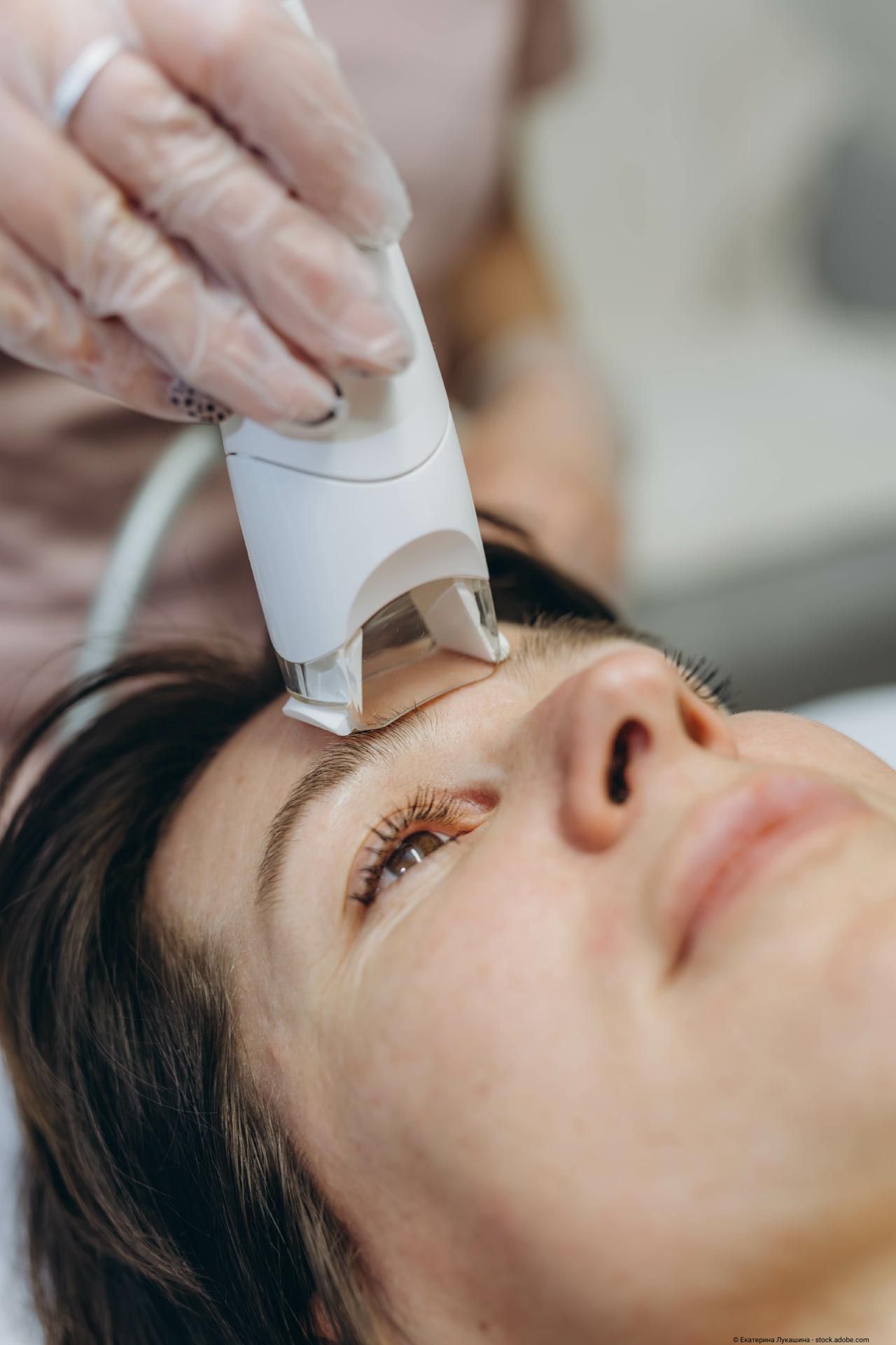 Junge Frau erhält eine Endermologie-Behandlung im Gesicht