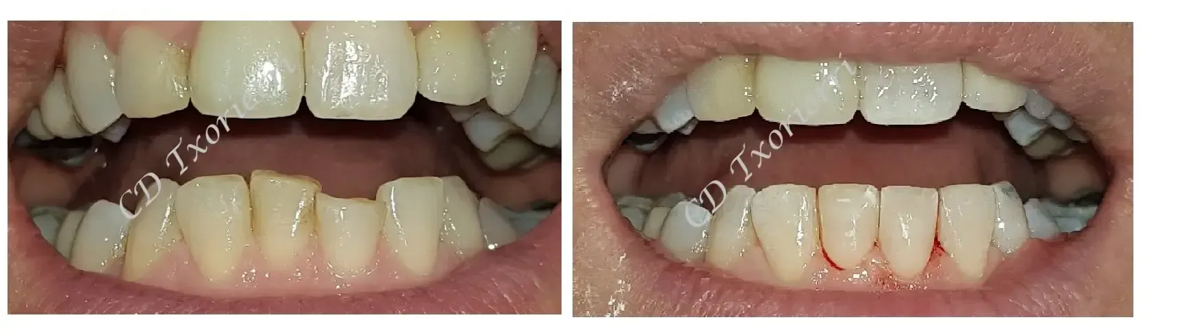Una fotografía de antes y después de los dientes de una persona.