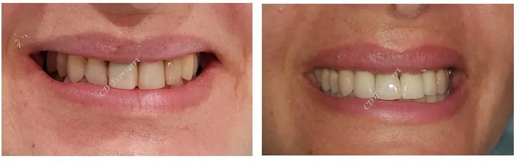 Una fotografía de antes y después de los dientes de una mujer.
