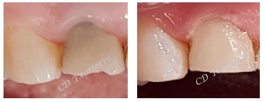 Una fotografía de antes y después de los dientes de una persona.