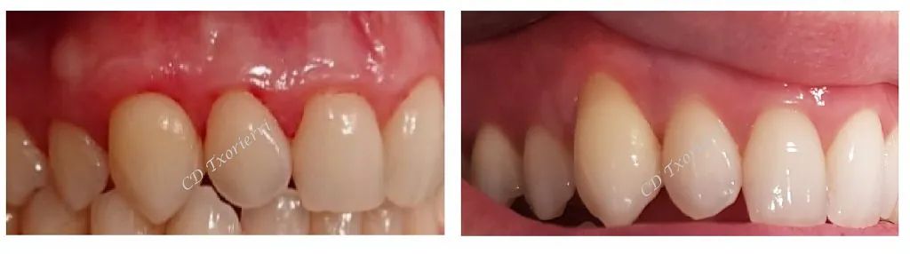 Una fotografía de antes y después de los dientes de una persona.