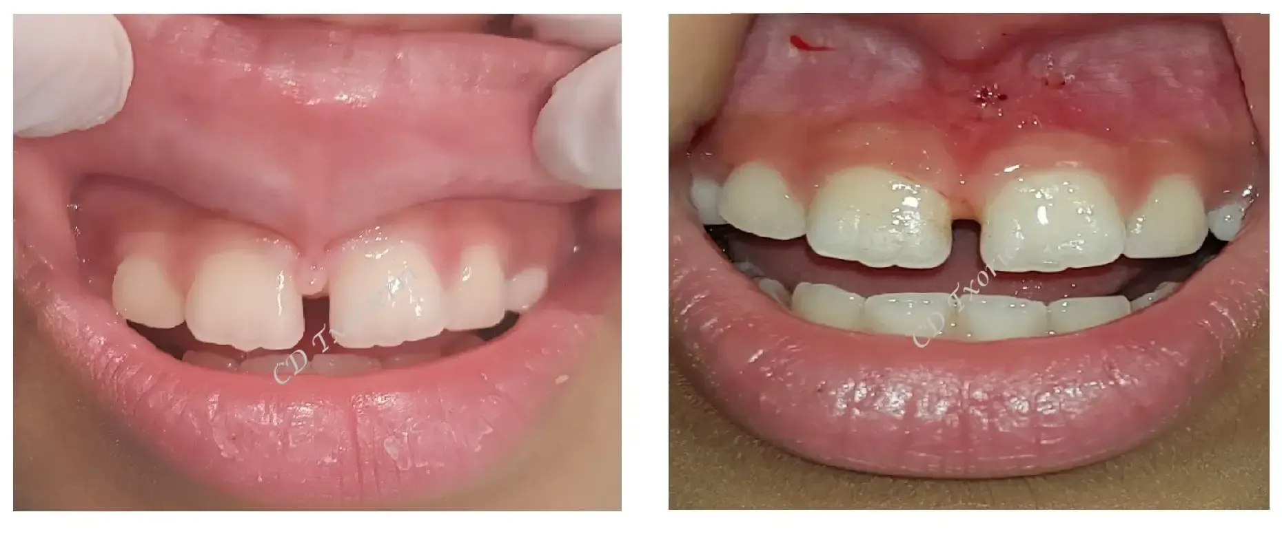Una fotografía de antes y después de los dientes de una persona.