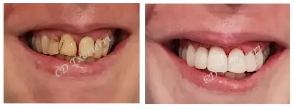 Una fotografía de antes y después de los dientes de una persona.