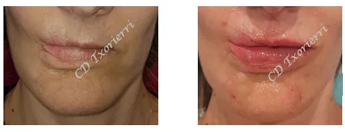 Una foto de antes y después de los labios de una mujer.
