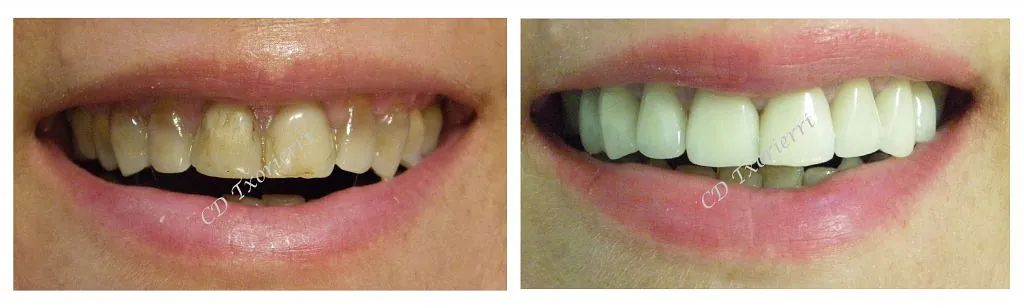 Una fotografía de antes y después de los dientes de una mujer.
