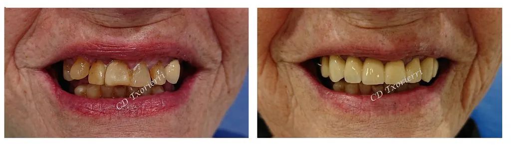 Una fotografía de antes y después de los dientes de una persona.