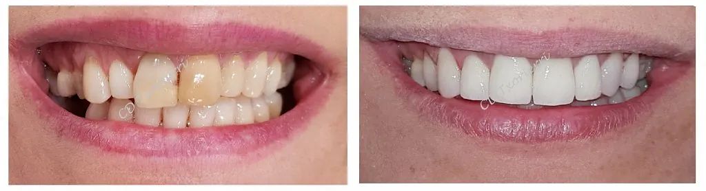 Una fotografía de antes y después de los dientes de una mujer.