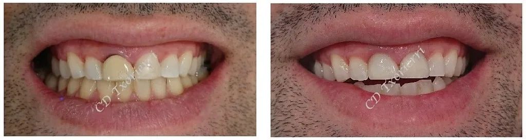Una foto de antes y después de los dientes de un hombre.