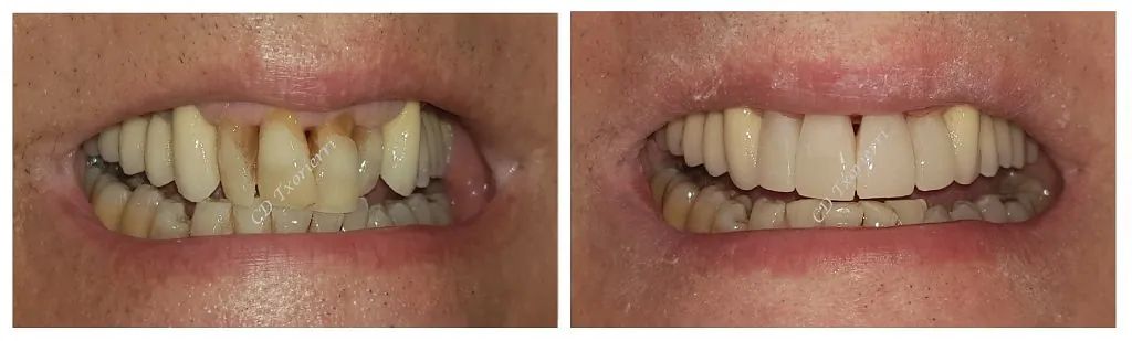 Una fotografía de antes y después de los dientes de una persona.