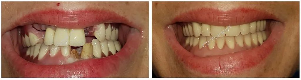 Una fotografía de antes y después de los dientes de una mujer.