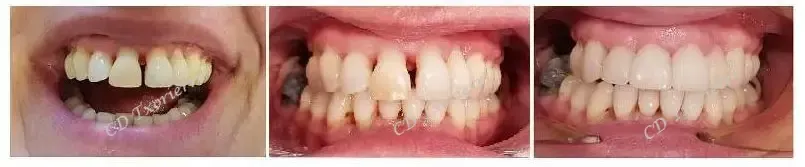 Un primer plano de los dientes de una persona antes y después del blanqueamiento.