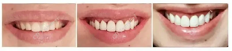 Tres imágenes de la boca de una mujer con diferentes tipos de dientes.