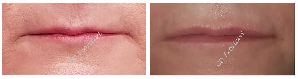 Una fotografía de antes y después de los labios de una mujer.