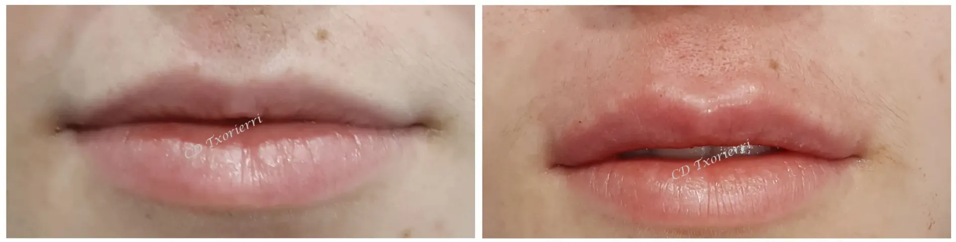 Una fotografía de antes y después de los labios de una mujer.