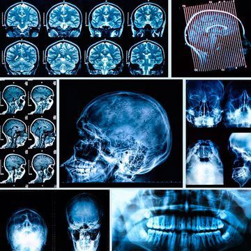 Un collage de radiografías de un cráneo y un cerebro.