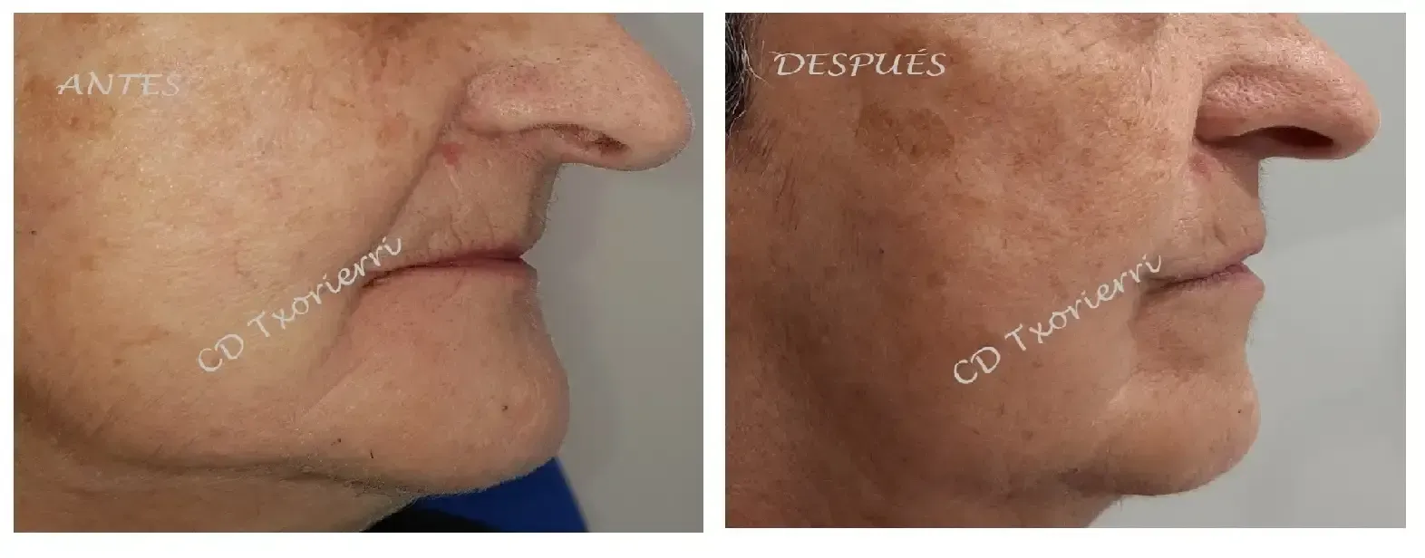 Una fotografía de antes y después de la cara de una mujer mayor.