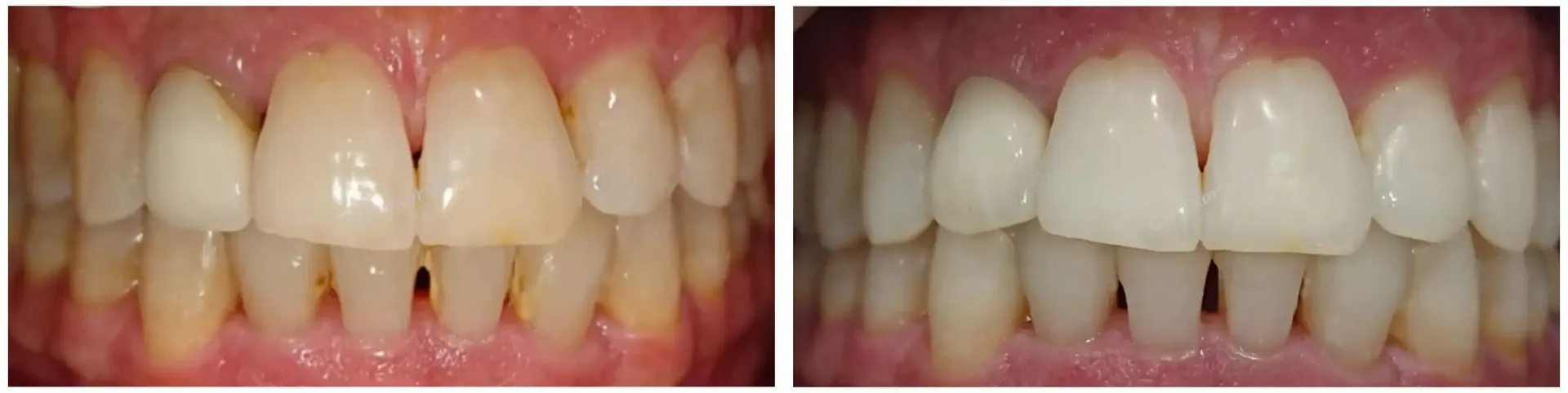 Una fotografía de antes y después de los dientes de una persona.