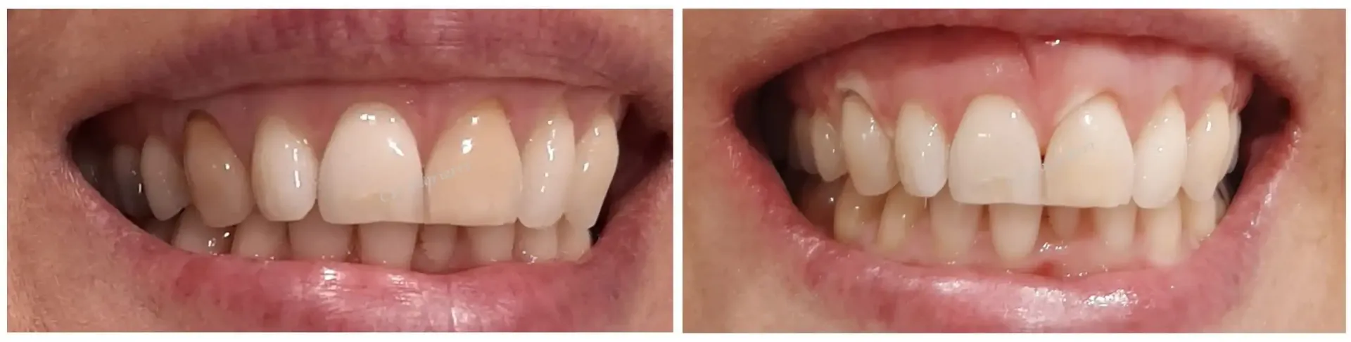 Una fotografía de antes y después de los dientes de una persona.