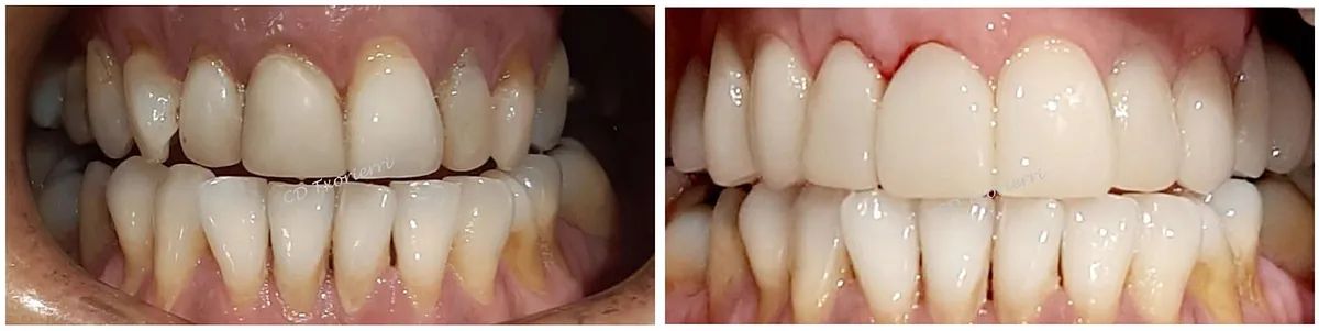 Una fotografía de antes y después de los dientes de una persona.