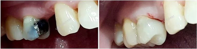 Una fotografía de antes y después de los dientes de una persona.