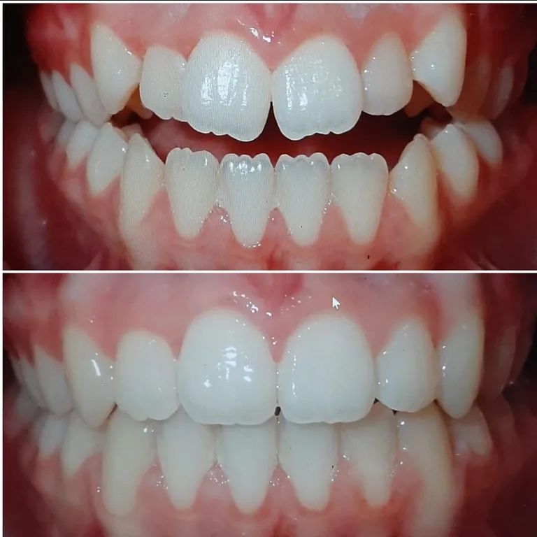 Una fotografía de antes y después de los dientes de una persona.