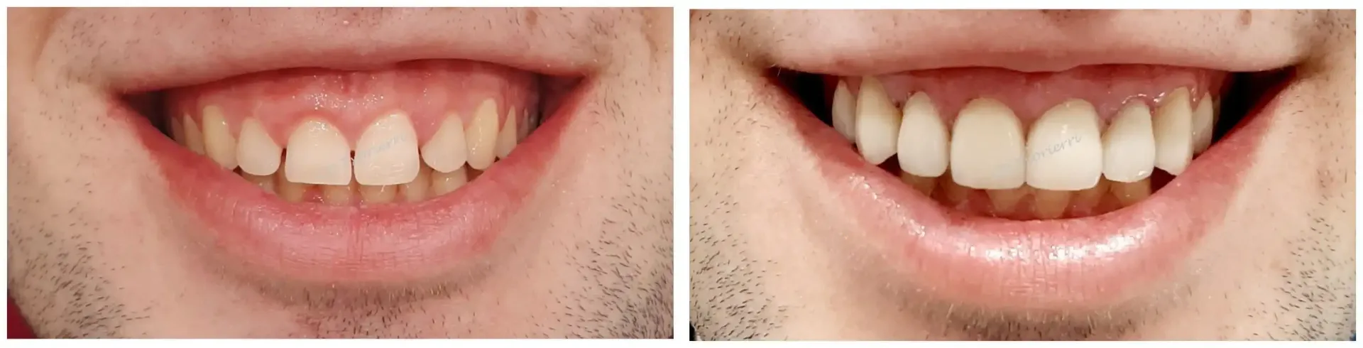 Una fotografía de antes y después de los dientes de un hombre.