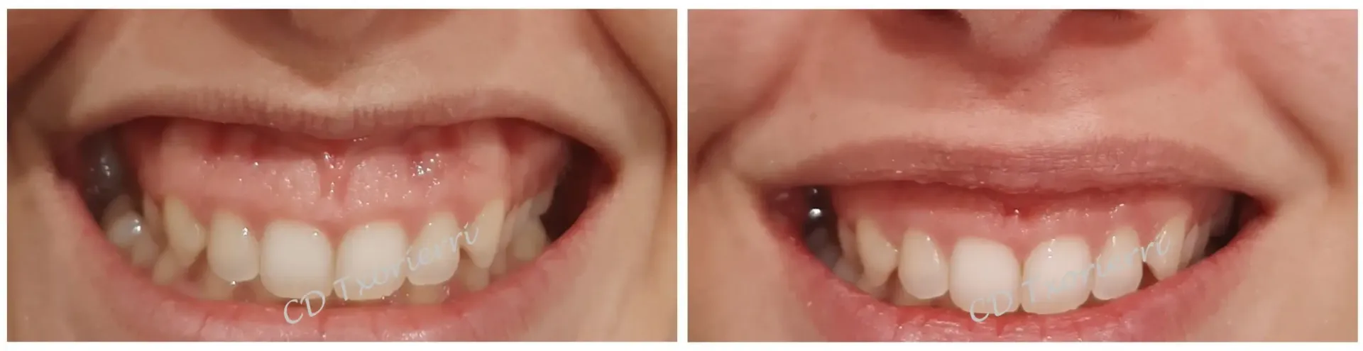 Una fotografía de antes y después de los dientes de una persona.