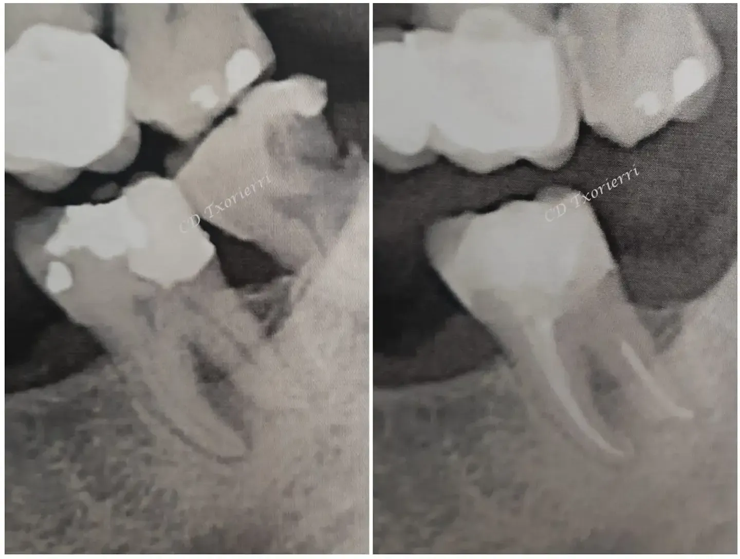 Una fotografía en blanco y negro de los dientes de una persona antes y después de una extracción dental.