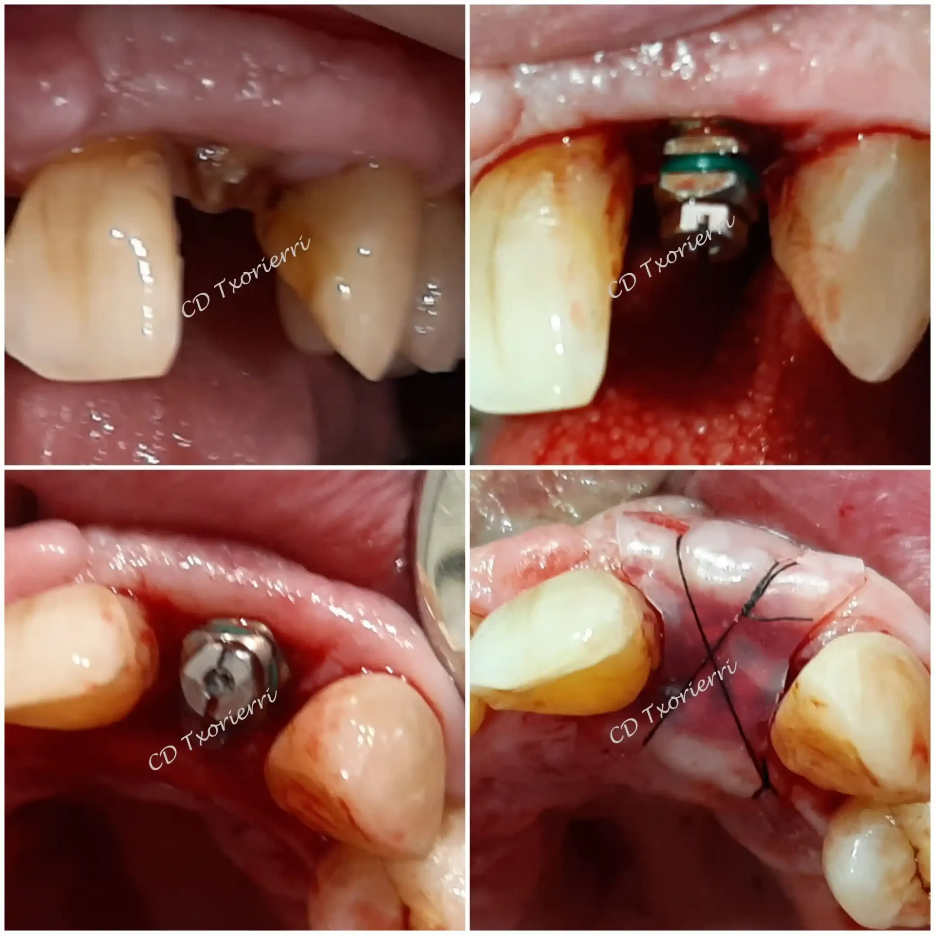 Un collage de cuatro imágenes de los dientes de una persona con las letras CD escritas en la parte inferior.