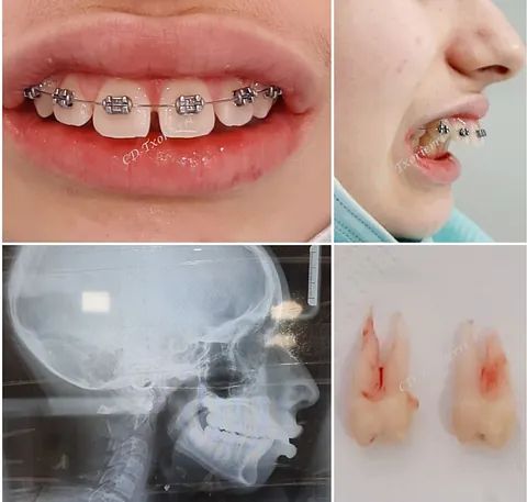 Un primer plano de la boca de una persona con aparatos ortopédicos y una radiografía del cráneo.
