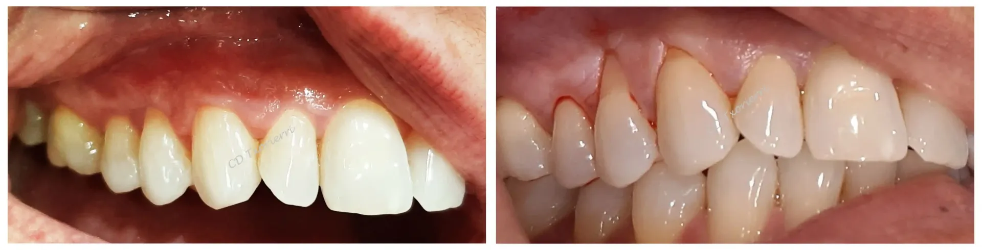 Una fotografía de antes y después de los dientes de una persona.