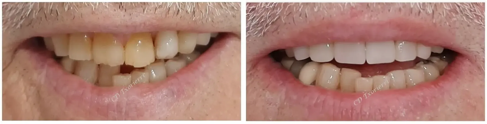 Una fotografía de antes y después de los dientes de un hombre.