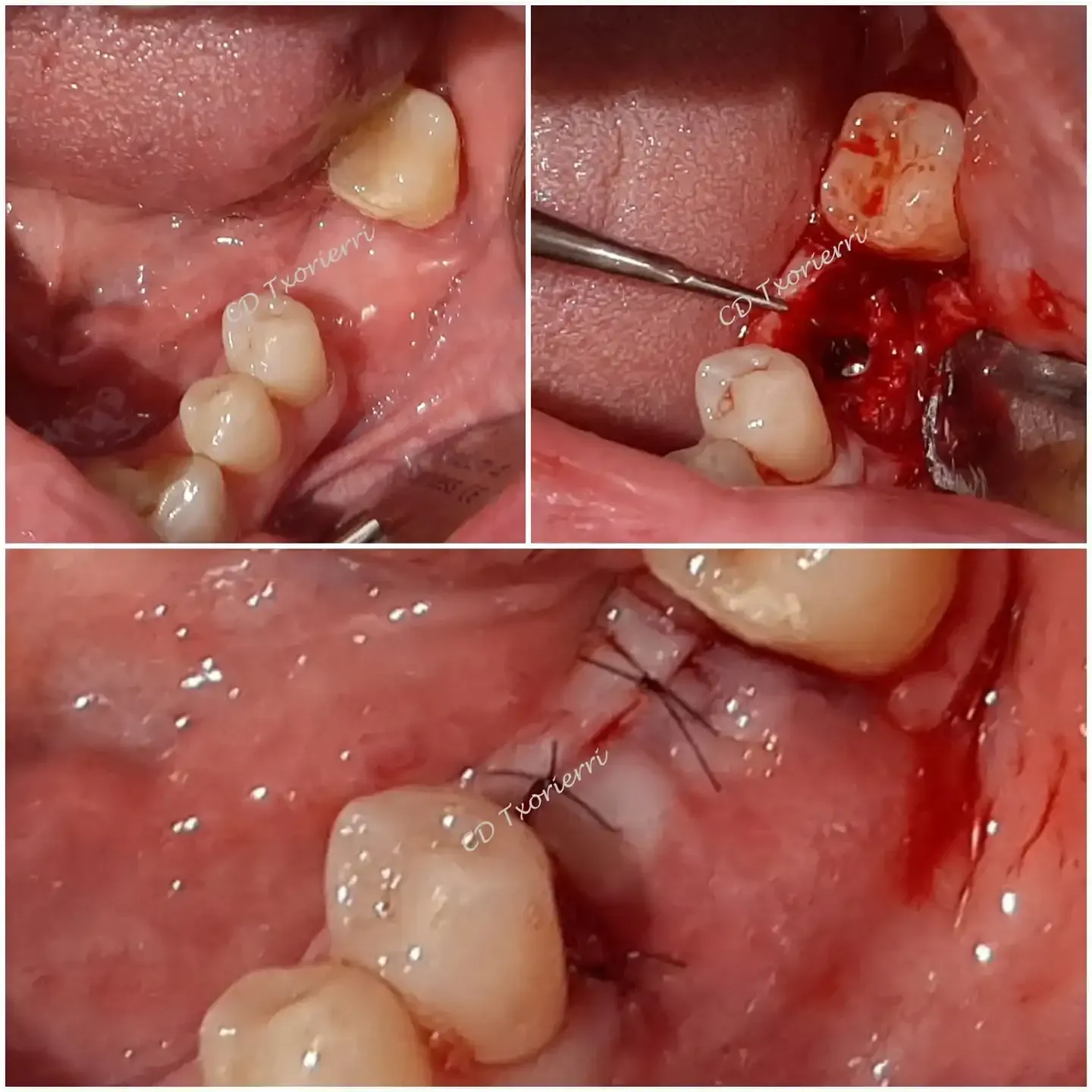 cirugia dental