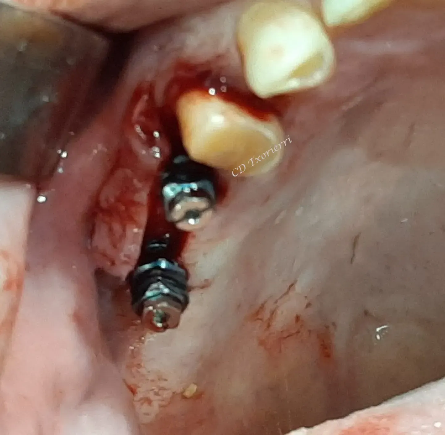 implantación de puentes 