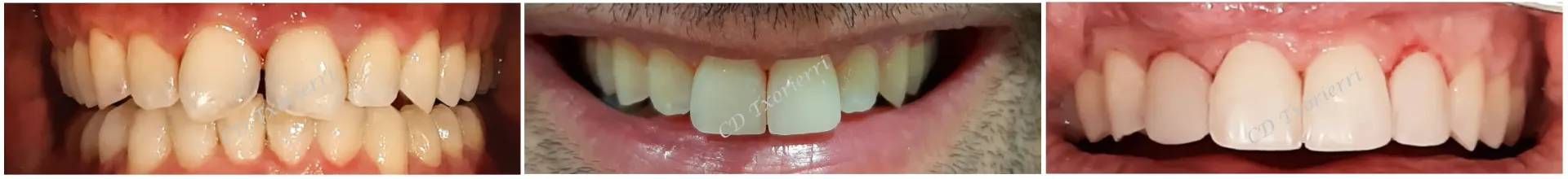 Un collage de tres imágenes de los dientes de una persona.