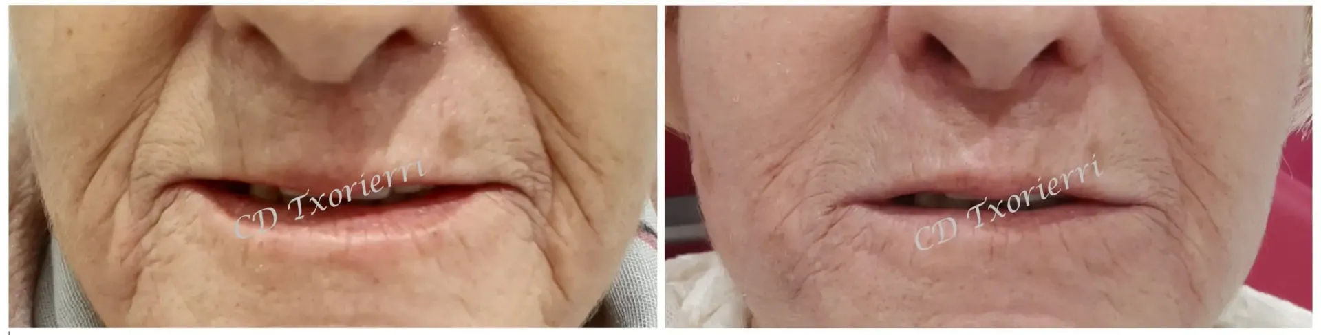 Una fotografía de antes y después del rostro de una mujer mayor.