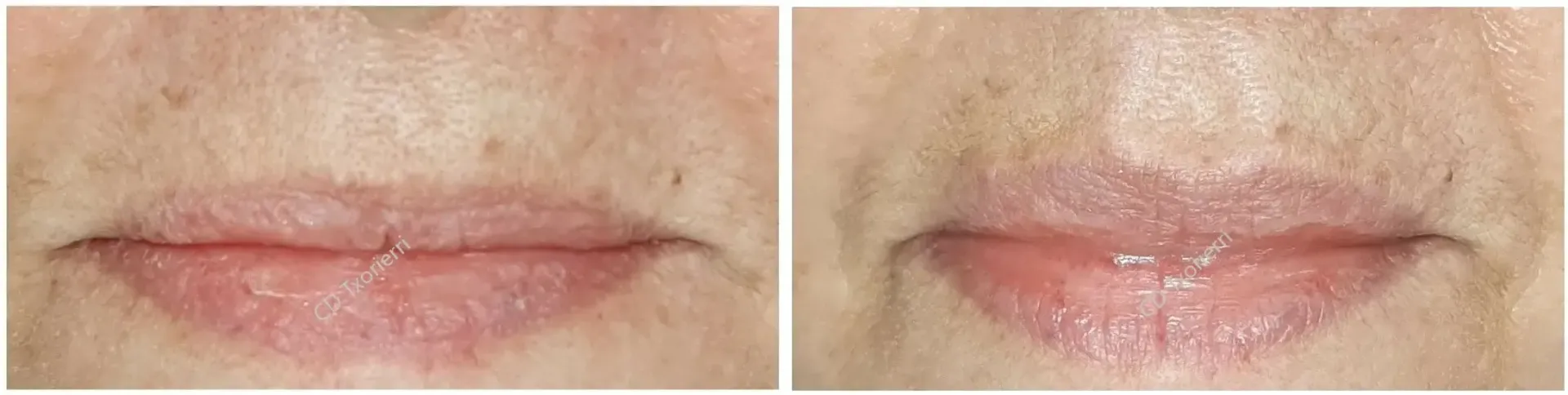 Una fotografía de antes y después de los labios de una mujer.