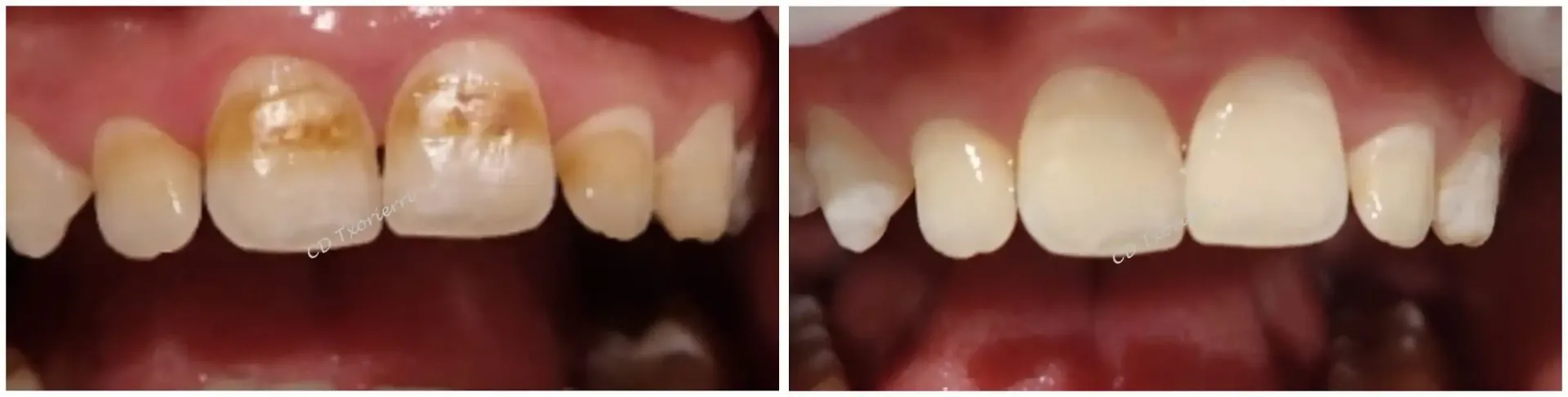 Una fotografía de antes y después de los dientes de una persona.